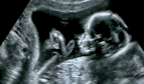 Tıp tarihinde bir ilk! Anne karnındaki bebeğe beyin ameliyatı yapıldı resim: 0