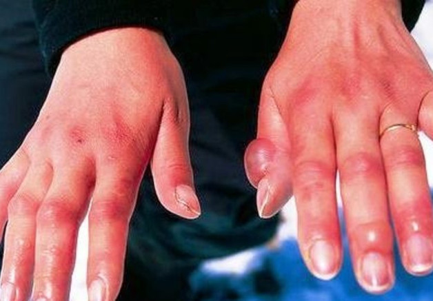 Soğuk ısırması nedir? İşte dikkat edilmesi gerekenler resim: 0