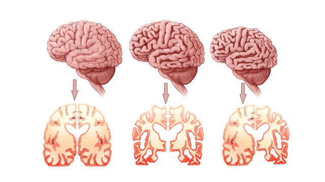 21 Eylül Dünya alzheimer günü: Annenizi, babanızı, çocuklarınızı ve torunlarınızı unutmamak için… resim: 1