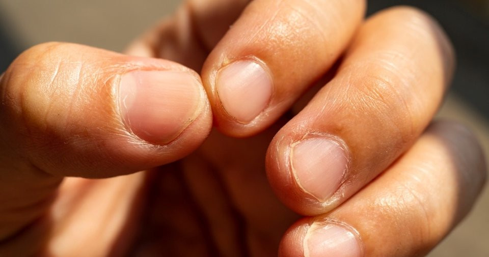 Tırnak ve parmaklardaki değişimler hastalık habercisi! İşte o hastalıklar...
