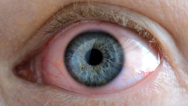 Göz sağlığına dikkat! İşte yapmanız gerekenler...