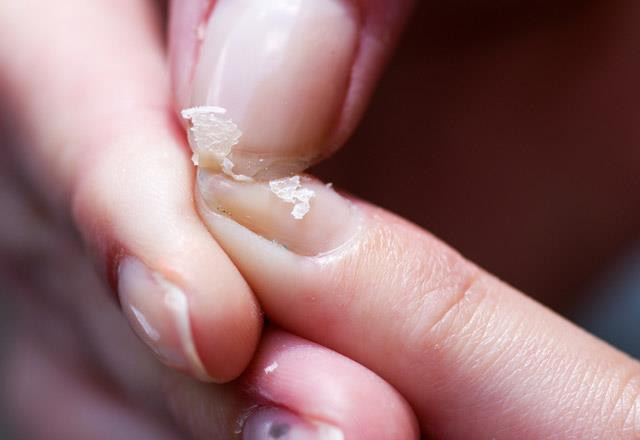 Tırnaklardaki değişiklikler hastalık habercisi!