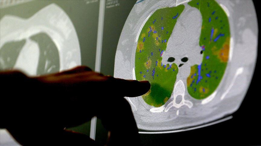 Kovid-19 virüsü beyin hücreleriyle birleşiyor